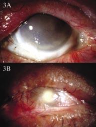 1068 Joseph, Dua, King Figure 3 Clinical photographs (A) of the right eye of case 2 few months after the large corneal graft and AMT; note the intense white colour of the ischaemic inferior limbus;