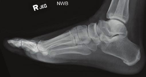 Surgical Off-loading of Plantar Hallux Ulcerations These approaches can be used to treat DFUs. By Adam R.