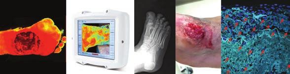 Alleviating increased plantar pressures in the foot, in addition to local wound care, is a key component to treating most diabetic foot ulcerations.