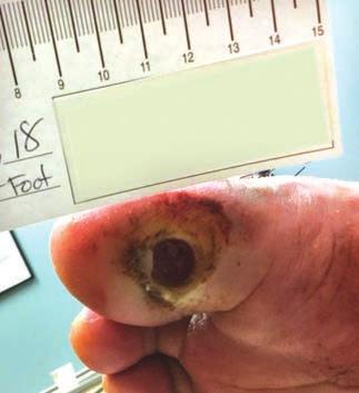 76 Figure 2: Ulceration at the plantar surface of right hallux in a 44-year-old male with diabetes mellitus.