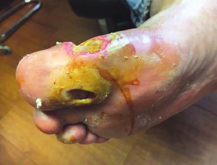 Hallux Ulcerations (from page 75) failed conservative measures. Figure 3 demonstrates resolution of this ulceration six weeks after the surgical intervention.