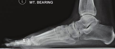 Figure 8: Lateral view plain radiograph demonstrating Moberg bunionectomy with hybrid staple-plate fixation.