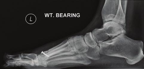 Hallux Ulcerations (from page 76) of fixation include the use of staples or small plates.