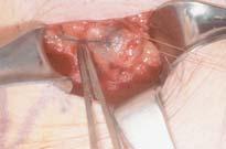 Nodal Surgery Sentinel Lymph Node Dissection Definition: A sentinel lymph node (SLN) is best defined as any node that receives direct lymphatic drainage from a primary tumor site Status of the SLN is