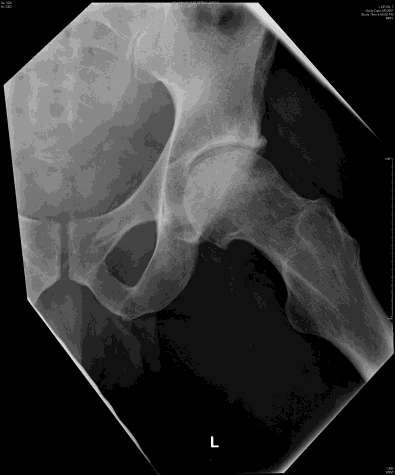 Primary Subchondral Fracture of the Femoral Head Elderly women with osteopenia and obesity Elderly patients Military