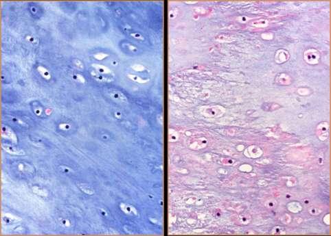 Well Differentiated Distinction between benign and malignant is difficult based only on histopathology.