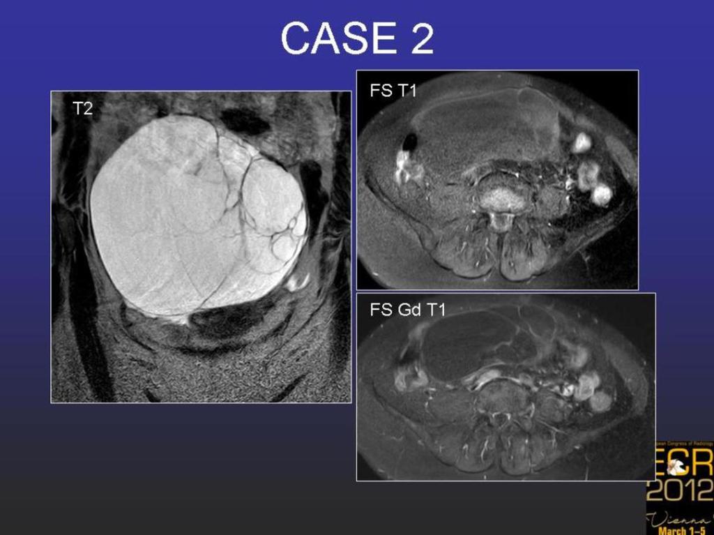 Fig. 7: Case 2. Mucinous cystadenoma.
