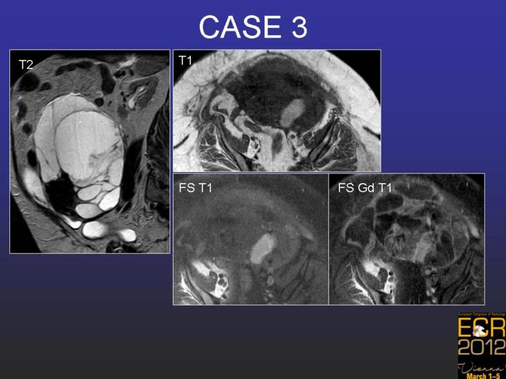 Fig. 8: Case 3. Mucinous cystadenocarcinoma.