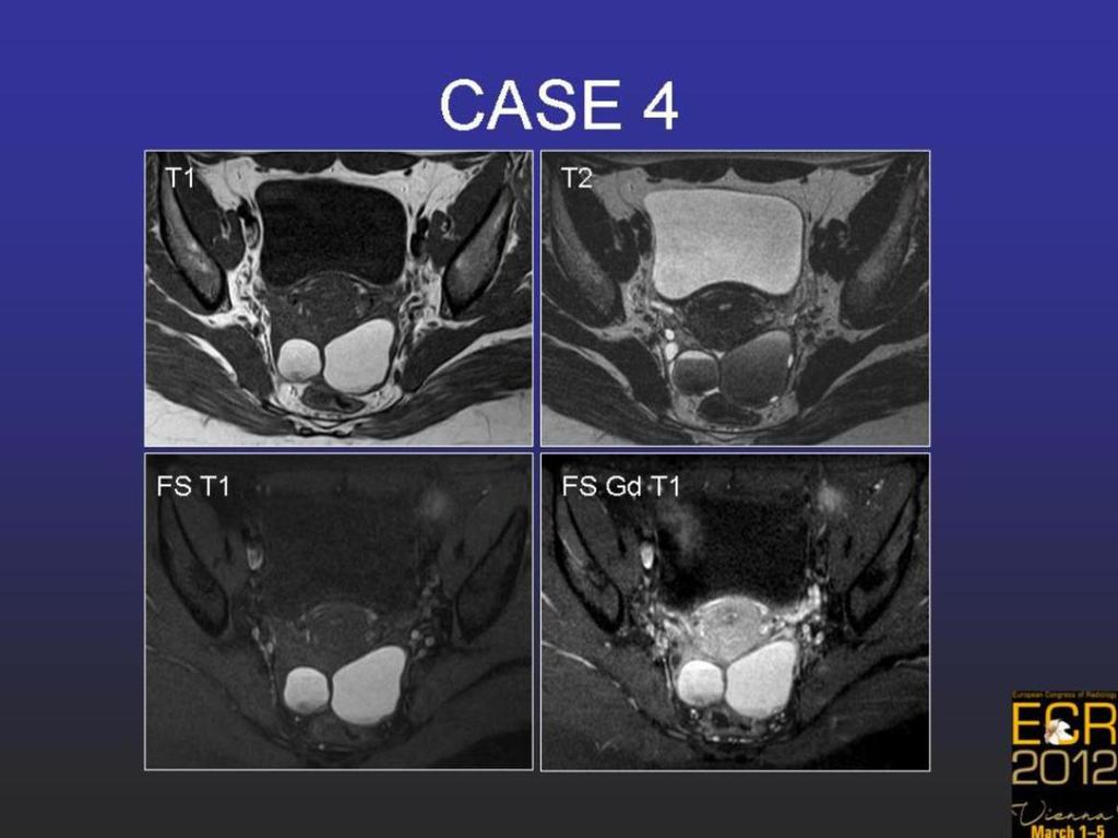 Fig. 9: Case 4. Bilateral endometriomas and pelvic endometriosis.