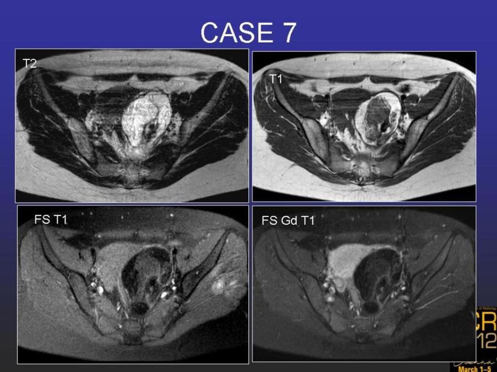 Fig. 12: Case 7. Mature teratoma.