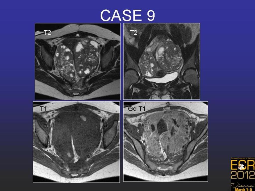 Fig. 14: Case 9. Gastric carcinoma metastasis.