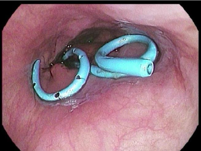 Internal drains Endoscopic view of