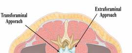 Endoscopic Transforaminal Suprapedicular Approach in High Grade Inferior Migrated Lumbar Disc Herniation. JKNS 2009 Kim HS et al.