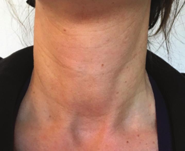 On the horizontal wrinkles, 1 2 U per point was injected every 1 2 cm using an intradermal bolus technique in the mandibular platysma (Nefertiti Lift) 6. Then two 2.