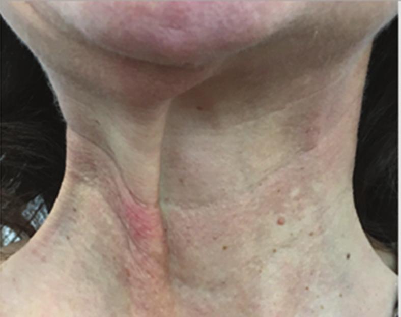 Therefore, the combination with Profhilo and botulinum toxin type A can be considered a good multi-modal approach to improve the overall quality of the neck.