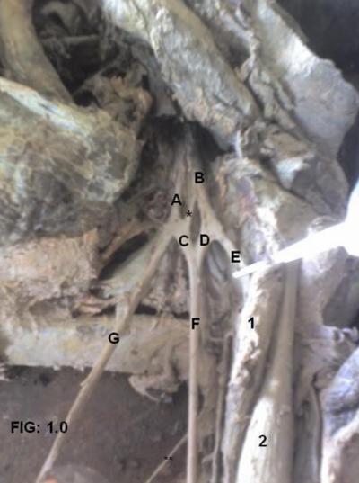 root of median nerve. The lateral cord also gave the lateral root of median nerve (D in Figure 1.0).