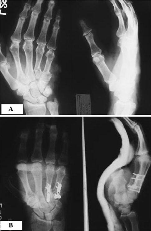 J Orthopaed Traumatol (2012) 13:29 33 31 Fig. 1 Case 1: a preoperative and b postoperative X-rays unstable hand fractures, results of closed treatment are usually unsatisfactory.