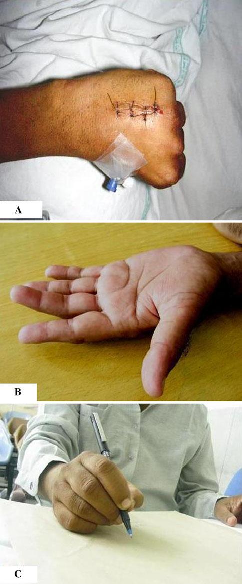 James reported loss of function in 77% of fingers with unstable phalangeal fracture treated by closed methods [18].