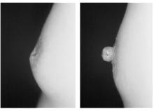 16. Dempsey WC, Latham WD. Subpectoral implants in augmentation mammaplasty : Preliminary report. Plast Reconstr Surg 1968 ; 42 : 515 17. Hoehler H. Breast augmentation : The axillary apporoach.