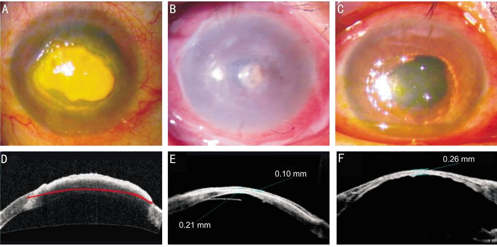 Amniotic membrane covering for fungal keratitis Figure 1 A case of the amniotic membrane covering group observed under slit lamp microscopy and As -OCT A, D: Before surgery; B, E: Two days after