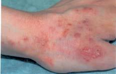 Case 3 A 22-year-old patient presents with papulopustulous lesions with erythema and desquamation, despite a powerful topical corticoid treatment for dermatitis. Tinea incognito.