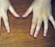 Case 4 A12-year-old girl was concerned about punctuate depressions on her fingernails. She also had erythematous plaques with fine, silvery scales on her knees. Her hair was normal.