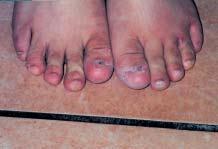 Case 5 On a routine physical examination, this five-yearold boy was noted to have absence of several toenails. According to his mother, the abnormality was present at birth. Anonychia.