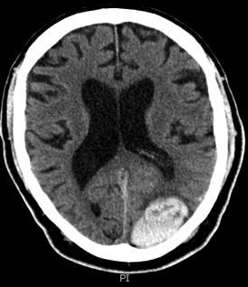 man in A fib on Xeralto, presents to ED with history of headaches for 2 days and trouble