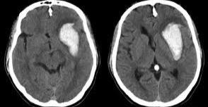 Hypertensive Stroke Hypertensive Stroke Cerebral Amyloid Angiopathy Can present single or mulitple spontaneous intracerebral