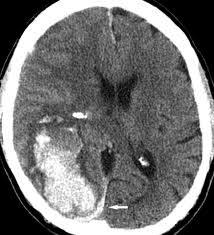 Amyloid Angiopathy Hemorrhagic transformation of ischemic CVA Occurs in about 10% 2
