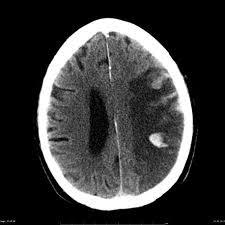 Hemorrhagic MCA infarct Subarachnoid Hemorrhage 42 year old woman presents to clinic with history of sudden onset