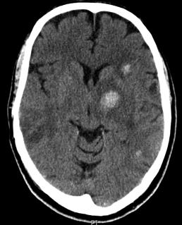 Hemorrhagic Tumor Case 1 Treatment Hurry! Treatment requires the same vigilance as the ischemic strokes being evaluated for tpa. 73% will increase in size over 3 hours.
