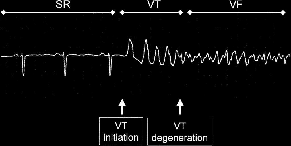 2820 Chaos and Fibrillation Figure 1. Surface ECG illustrating evolution of human VF from sinus rhythm (SR) to VT to VF.