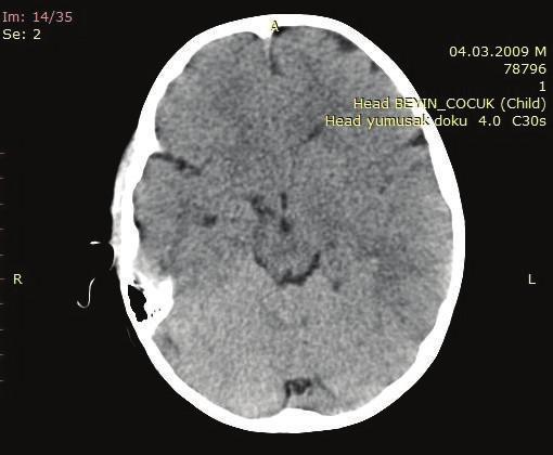 2 Case Reports in Medicine Figure 1: Axial CT
