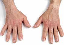 The only real complicating factor that we see when treating hands can be edema that may last a few days or as long as a week or two, he noted, and preliminary indications are good for using