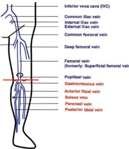 Classification of lower limb DVT Proximal DVT Popliteal EARLY TREATMENT AGGRESSIVE Femoral FULL DOSE ANTICOAGULANT Deep femoral Common femoral Iliac Distal DVT Gastrocnemius CONTROVERSIAL Tibial