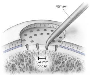 Micro fracture Marrow stimulation technique Most common Simple, safe, cheap