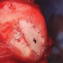 lesions <50 yrs old Larger lesions 2-8 cm