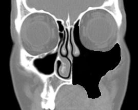 Johan Fagan Figure 29: Coronal CT demonstrating resected lateral nasal wall including inferior turbinate and uncinate process, orbital floor including the infraorbital nerve, the lamina papyracea and