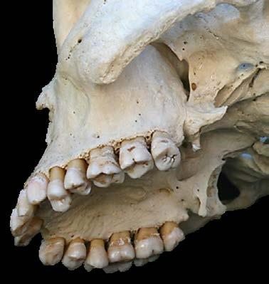 Johan Fagan Figure 37: Maxillectomy specimens Figure 35: Osteotomy between maxillary tuberosity & pterygoid
