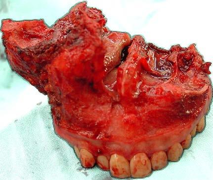 malar complex, sphenoid sinus, cribriform plate (craniofacial resection), contralateral maxilla (Figure 45), skin (Figure 46a-c), or orbit.