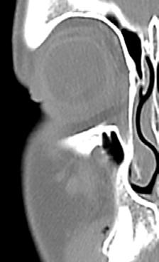 Open Access Atlas of Otolaryngology, Head & Neck Operative Surgery ethmoidal foramina and the infraorbital foramen.