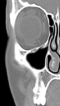 Infraorbital foramen Inferior turbinate Middle turbinate Uncinate process Infraorbital nerve Maxillary sinus Inferior turbinate Figure 5: Anatomy in the coronal plane through the anterior ethmoids