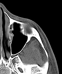 Orbital apex Infraorbital nerve Nasolacrimal duct Zygoma Pterygomaxillary fissure Pterygopalatine fossa Figure 9: Axial cut at level of infraorbital nerve and orbital floor Infraorbital foramen