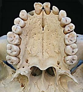 pterygopalatine fossa. Figures 9 & 10 illustrate axial views of the anatomy of the maxillary sinus.