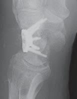 Postoperative X-rays