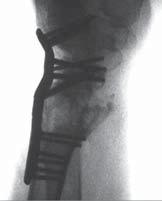 X-Ray Postoperative