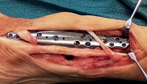 a bone graft Result after wrist fusion with