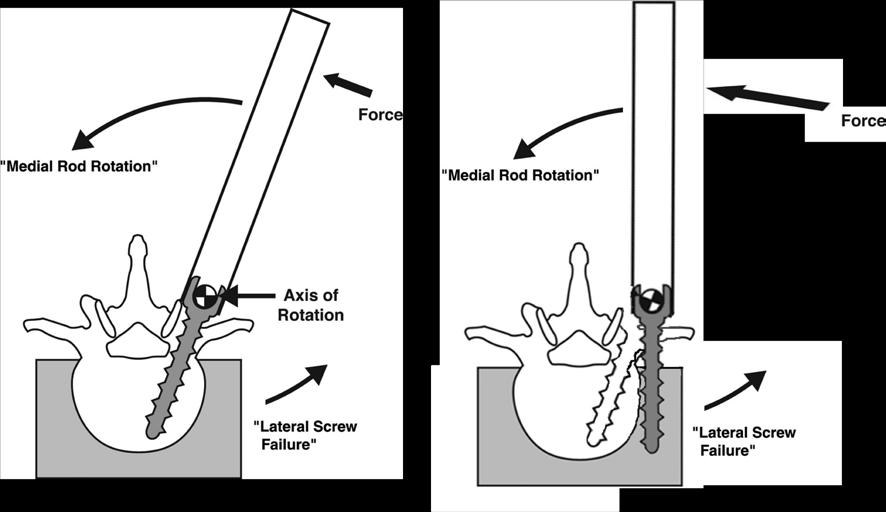 Pedicle characteristics as rotation, dysplasia, and length of pedicle make weak for maneuvers 2 Screw placed lateral and less bone quality increase risk of plow 3 DIRECT VERTEBRAL ROTATION (DVR)