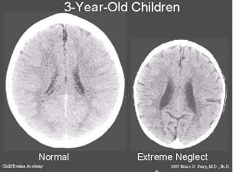 Neuro-imaging studies in orphanages: reduction in